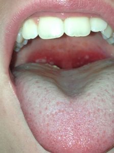 Can Toothbrush Cause Sore Throat