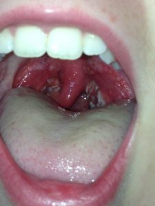 streptococcus throat